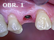 Zhojená sliznice v místě chybějícího zubu 14 s patrným implantátem