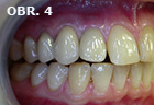 Umělé korunky nesené vlastními zuby 14, 13 a implantátem 12